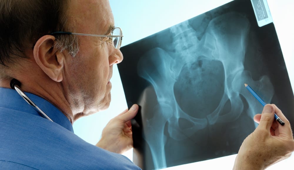 Doctor looking at hip bone scan